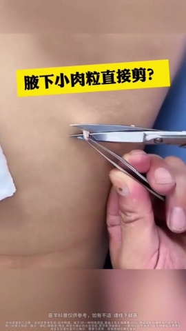 腋下小肉粒